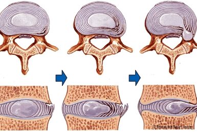 Voorbeeld annulus